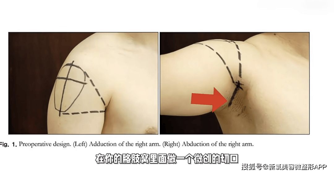 韩国男人往肩部埋双开门硅胶，20w人民币打成偏瘫？