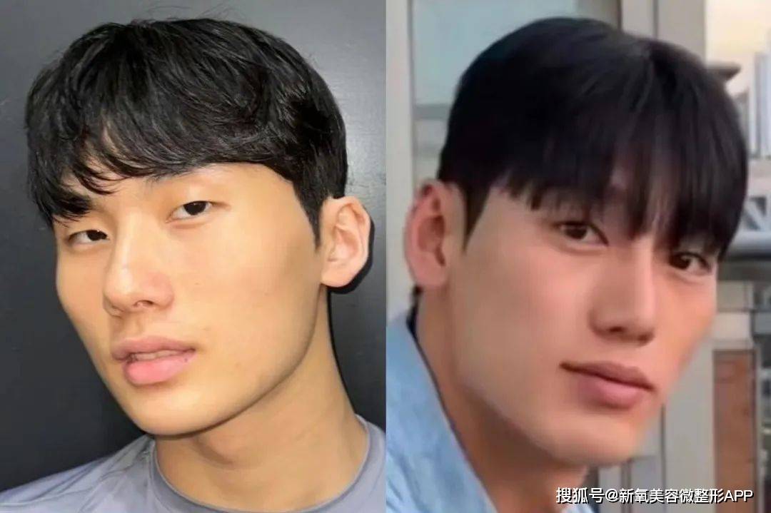 韩国男人往肩部埋双开门硅胶，20w人民币打成偏瘫？