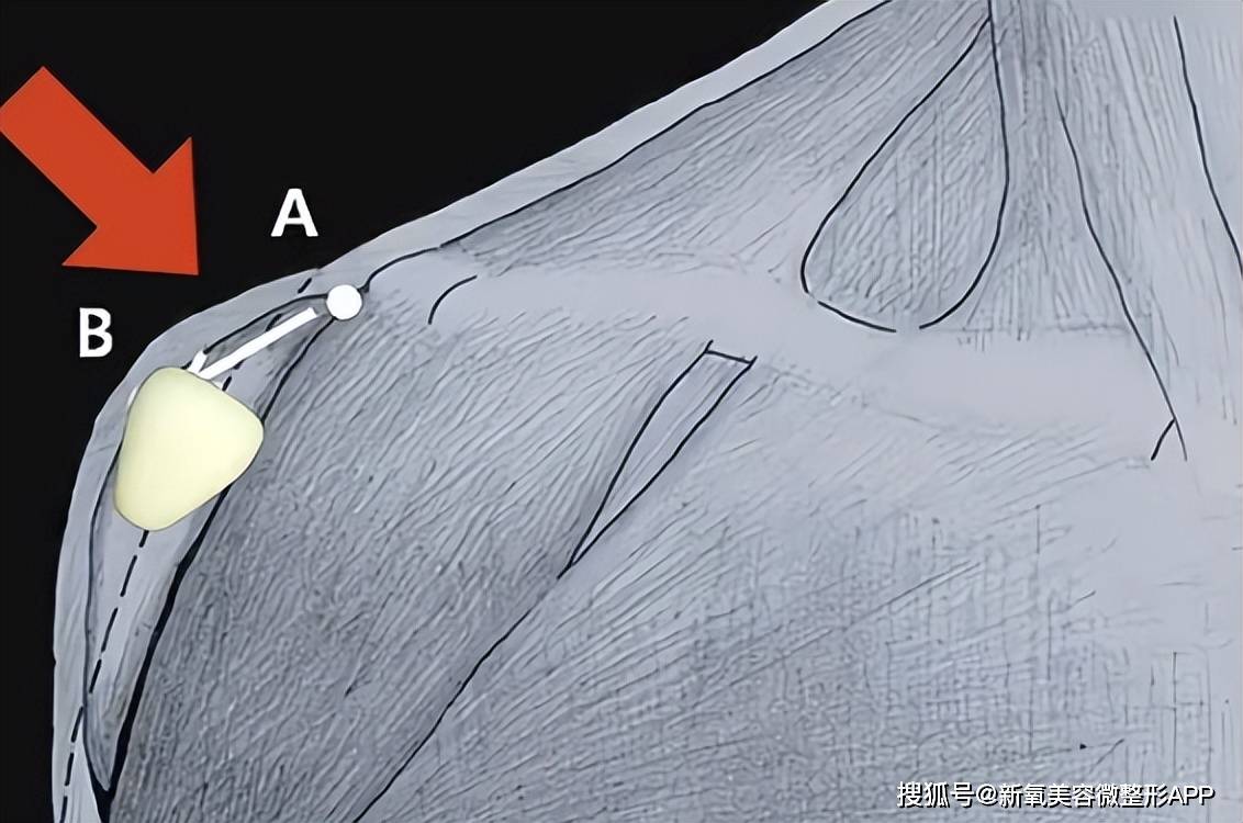 韩国男人往肩部埋双开门硅胶，20w人民币打成偏瘫？