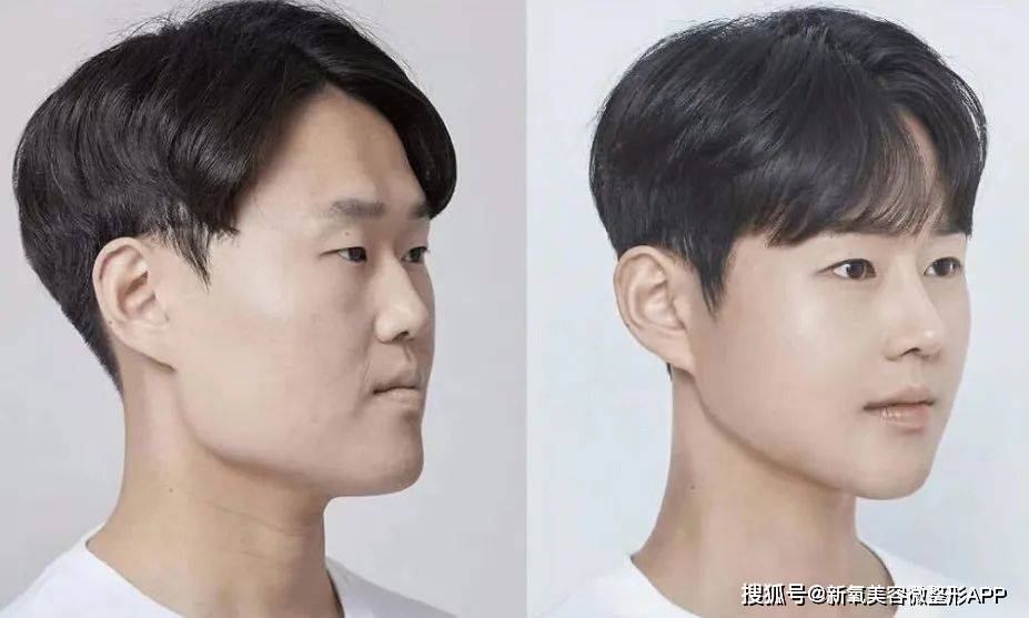 韩国男人往肩部埋双开门硅胶，20w人民币打成偏瘫？