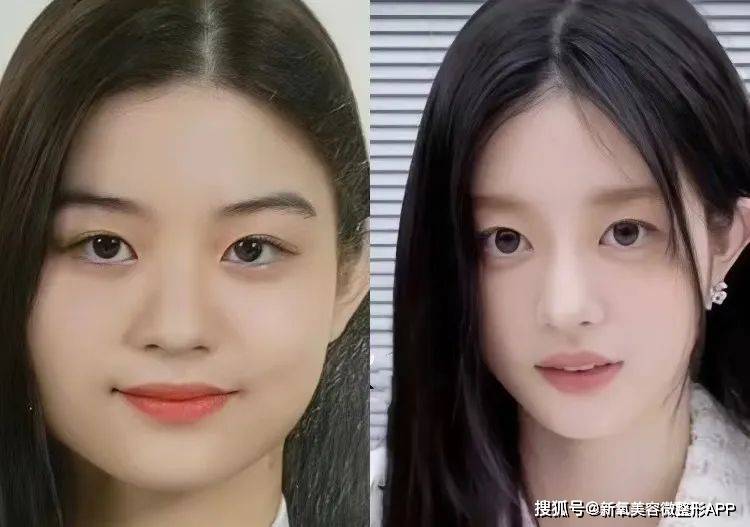 韩国男人往肩部埋双开门硅胶，20w人民币打成偏瘫？