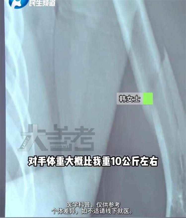 27岁女子参加掰手腕比赛,“咔嚓”一声手臂断了!医生:与对手强弱无关