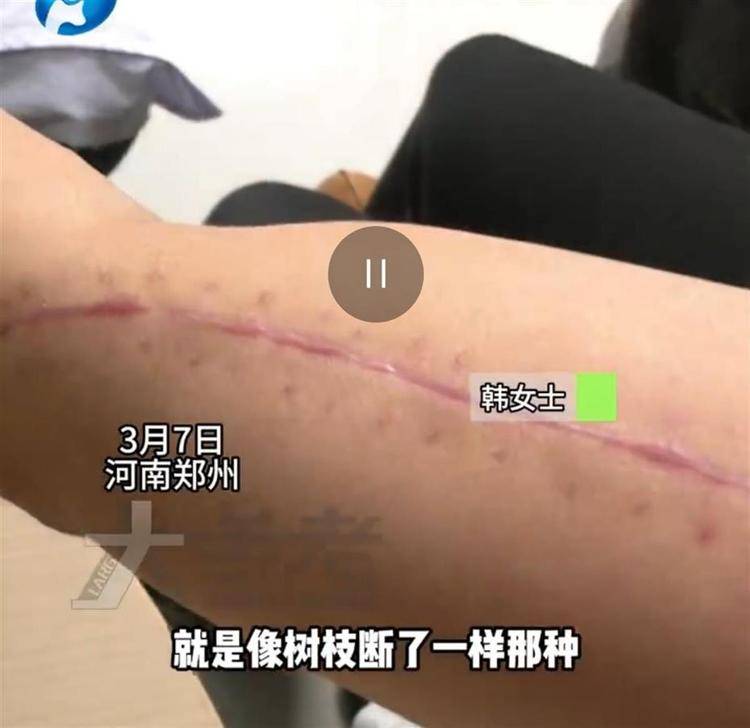 27岁女子参加掰手腕比赛,“咔嚓”一声手臂断了!医生:与对手强弱无关
